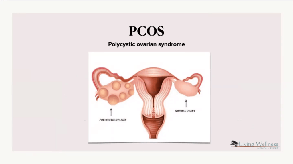 PCOS - polycystic ovarian syndrome