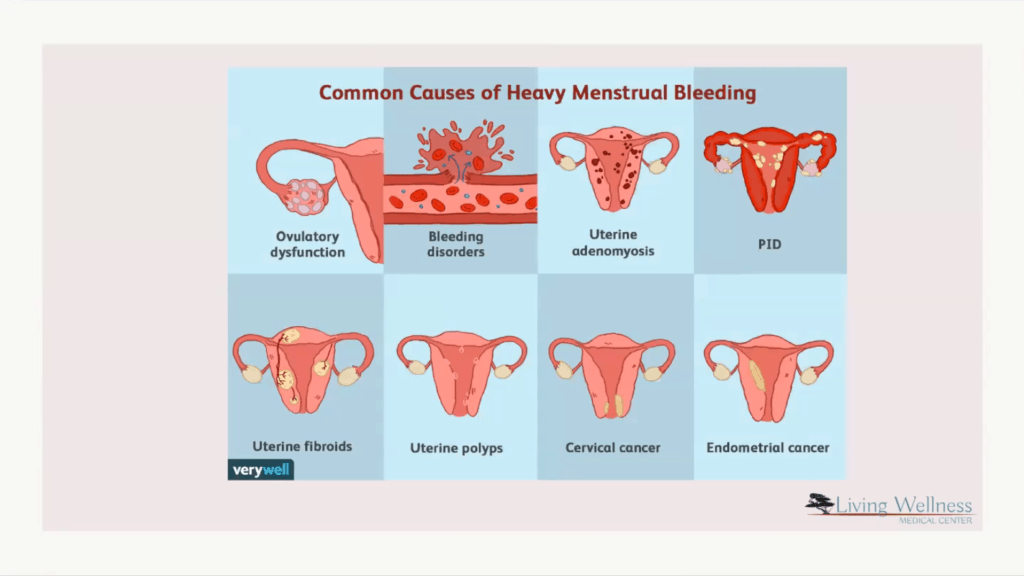 Common causes of heavy menstrual bleeding infographic